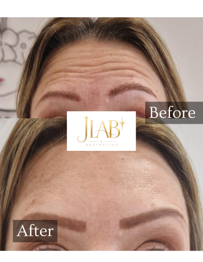 botox burton on trent