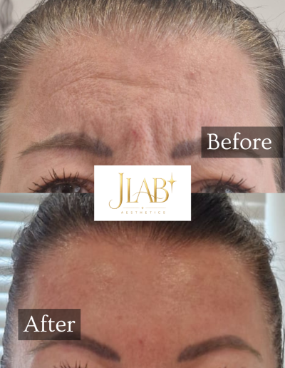 anti wrinkle injections burton on trent