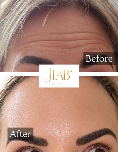 anti wrinkle injections burton