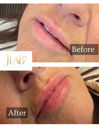 lip enhancement drakelow