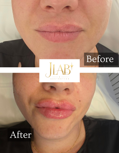 lip filler burton on trent