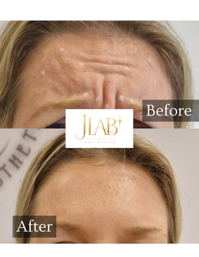botox drakelow